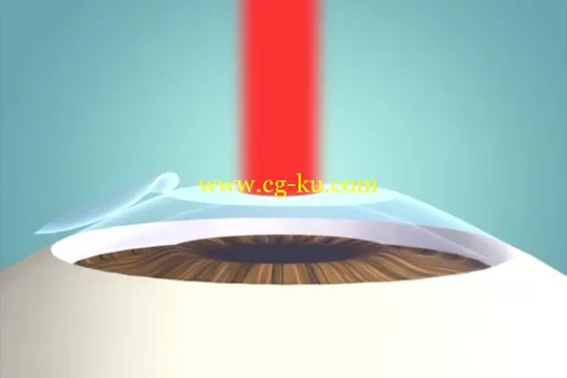 Understanding LASIK and Wavefront Patient Education的图片6